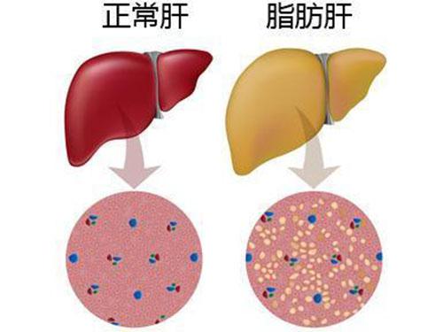 脂肪肝怎么调理 脂肪肝怎么调理最好最快