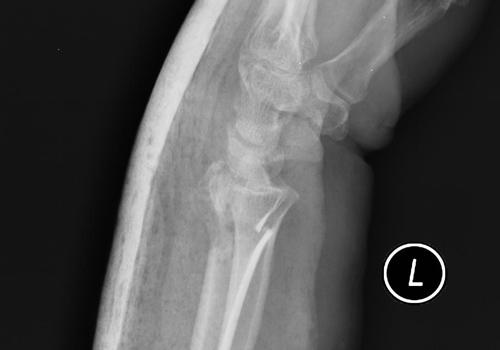 骨折复位标准 桡骨远端骨折复位标准