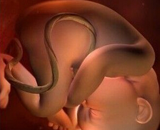 胎儿脐带绕颈怎么办 古代胎儿脐带绕颈怎么办