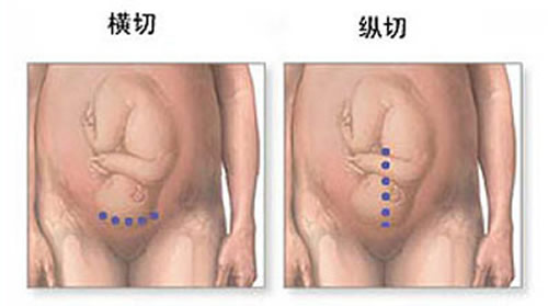 剖腹产横切还是竖切好（剖腹产手术横切好还是竖切好）