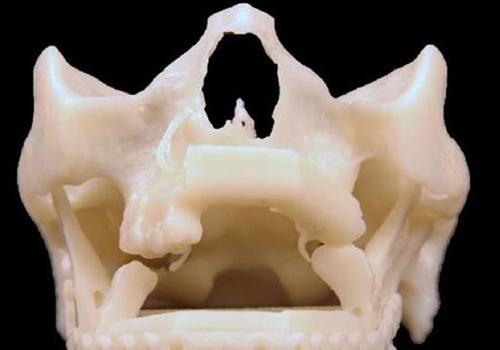 颌骨骨折的临床表现 上颌骨骨折的临床表现
