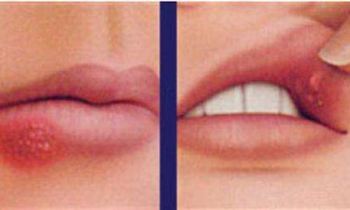 嘴唇上长泡是什么原因 月经期间嘴唇上长泡是什么原因