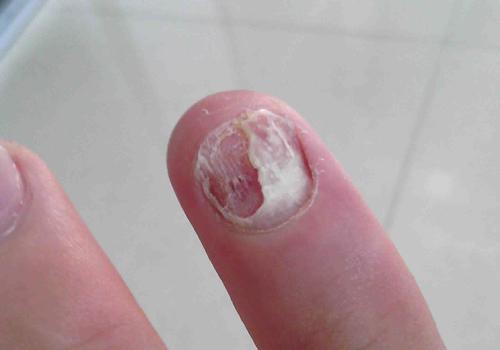 指甲脱落是什么原因 指甲脱落是什么原因引起的