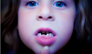 儿童换牙期注意事项 儿童换牙期注意事项及换牙顺序