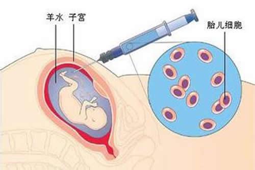 羊水穿刺什么时候做 羊水穿刺什么时候做最安全