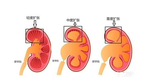 肾积水有哪些症状（肾积水有哪些症状最为明显）