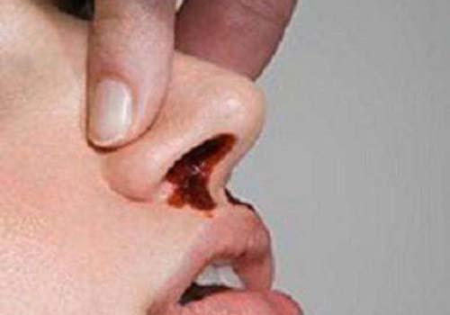 流鼻血是什么引起的 经常流鼻血是什么引起的