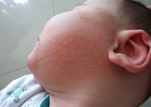 宝宝吃奶粉过敏的症状（宝宝吃奶粉过敏的症状是什么）