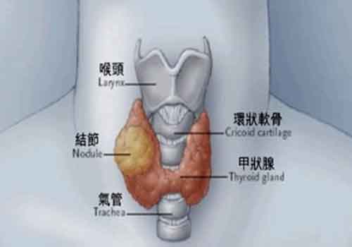 甲状腺结节能治愈吗 甲状腺结节能治愈吗?