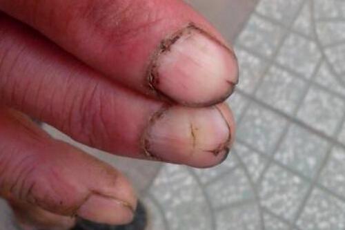 指甲裂开是什么原因 指甲裂开是什么原因怎样预防