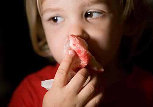 小孩流鼻血是什么原因（小孩流鼻血是什么原因怎样处理）