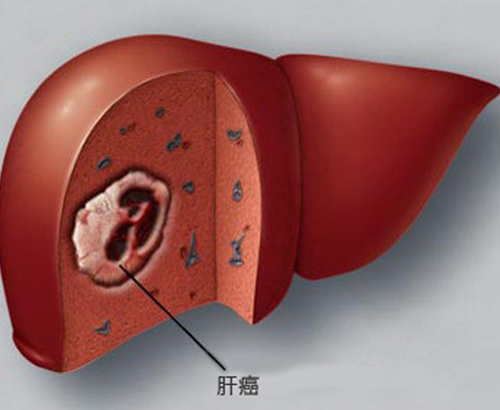 肝癌的早期症状 肝癌的早期症状女性