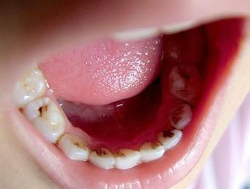 龋齿的危害有哪些 龋齿的危害有哪些?简答题