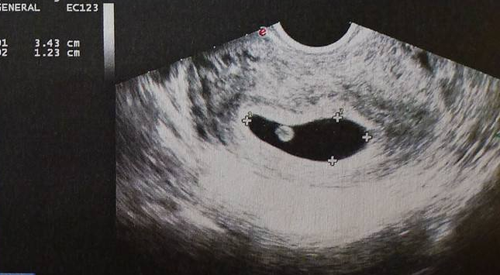 怀孕两个月孕囊大小多少正常 孕两个月孕囊大小是多大