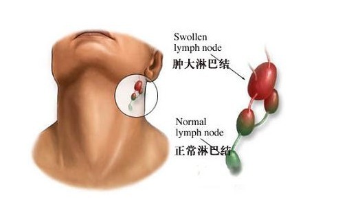 淋巴癌的早期症状