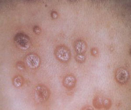 二期梅毒的症状 二期梅毒的症状和图片