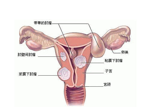 子宫肌瘤常见并发症 子宫肌瘤的并发症状