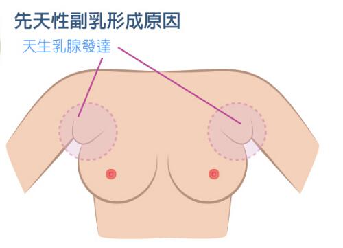 副乳的危害（副乳的危害有多大）