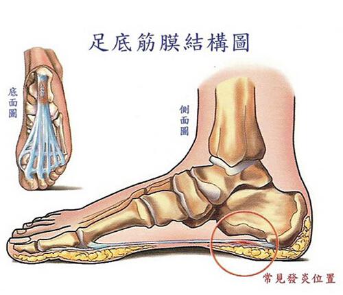 脚跟底部疼是怎么回事 脚跟底部疼是怎么回事儿