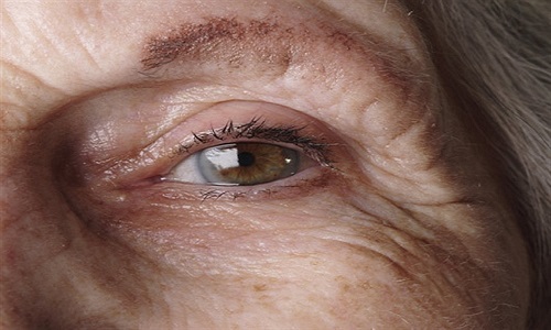 青光眼的早期症状是什么样子