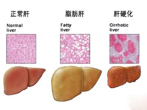 脂肪肝患者注意事项 脂肪肝应注意的事项