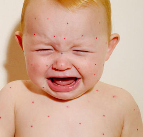 风疹的症状 儿童热风疹的症状