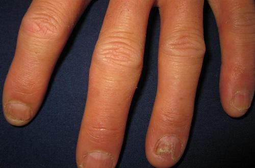 灰指甲有哪些类型 灰指甲有哪些类型图片