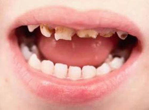 乳牙龋齿会影响恒牙长 恒牙旁边的乳牙得了龋齿,会影响到恒牙吗