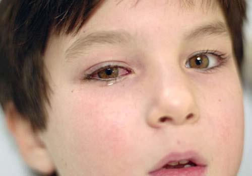 结膜炎和红眼病的区别（）