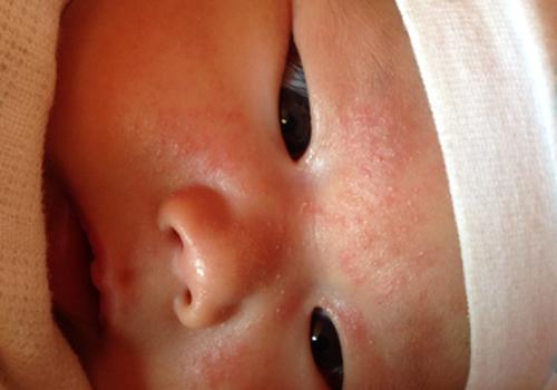 宝宝湿疹起皮是不是快好了 宝宝湿疹好了起皮怎么回事