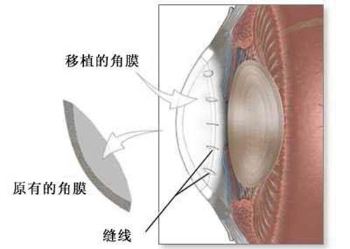 眼角膜是什么 眼角膜是什么样子的图片