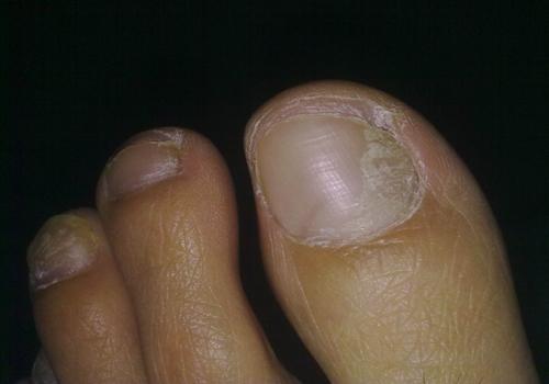 灰指甲不治疗的后果 灰指甲不治疗有什么严重后果