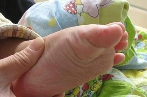 手足口病的预防措施 小儿手足口病的预防措施