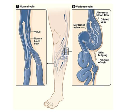 下肢静脉曲张有什么危害 下肢静脉曲张有什么危害呢