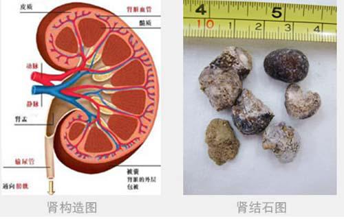 肾结石需要做手术吗（8mm的肾结石需要做手术吗）