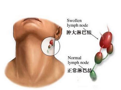 淋巴瘤四大临床表现是神马 淋巴瘤的表现是什么