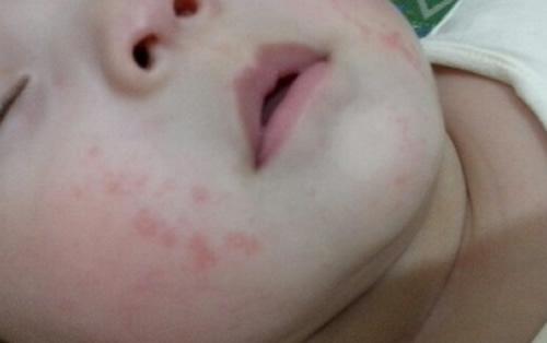 宝宝湿疹的症状 宝宝湿疹的症状和治疗方法