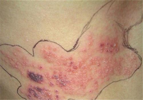 带状疱疹传染途径 带状疱疹传染途径是什么需警惕三大传染途...