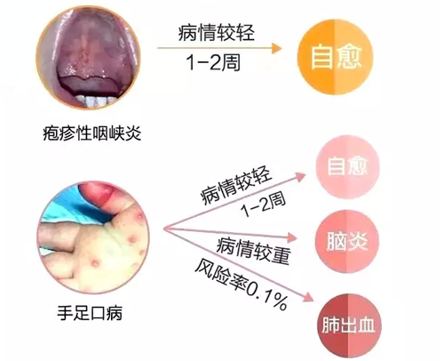 疱疹性咽峡炎和手足口病的区别（疱疹性咽峡炎和手足口病的区别是什么）