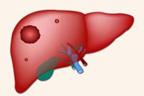 肝癌有哪些典型的症状（肝癌的主要症状有哪些）