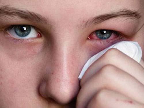 红眼病怎么治疗最快 红眼病怎么治疗最快好几天能好宝宝发烧外眼角特别红