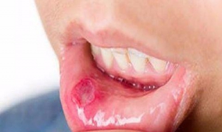 口腔溃疡怎么办 4种方法治疗口腔溃疡