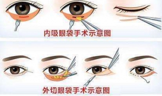 去眼袋最有效的方法 5个方法去眼袋