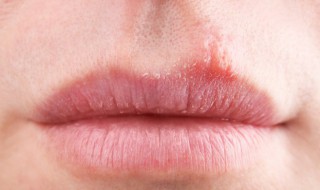 嘴唇干裂能不能用舌头舔 嘴唇干裂能否用舌头舔