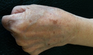 手背长老年斑怎么办 4 种方法可以淡化老年斑