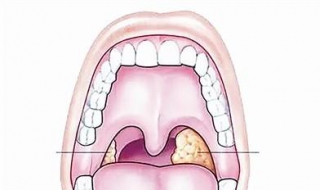 扁桃体化脓怎么办 三种常规治疗方法分享