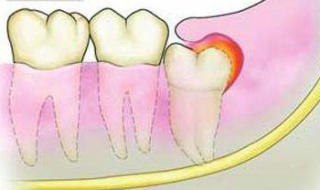 牙龈肿痛怎么办 时刻注意口腔卫生