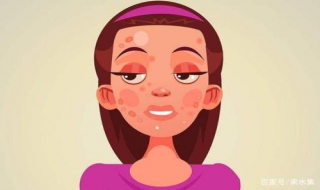 面部痤疮怎么办 日常要怎么注意皮肤护理