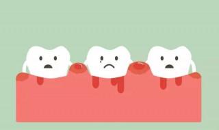 如何去除牙结石 牙结石的形成原因与处理方法
