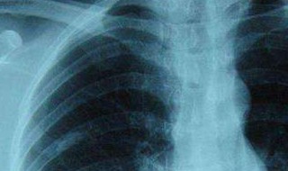 什么是肺纤维钙化 肺纤维钙化属于什么病
